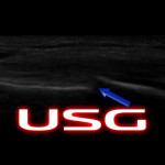 Kırık tanısında USG yeterli mi?