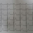 Senkop hastası ve EKG’si – Tanınız Nedir?
