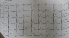 Senkop hastası ve EKG’si – Tanınız Nedir?