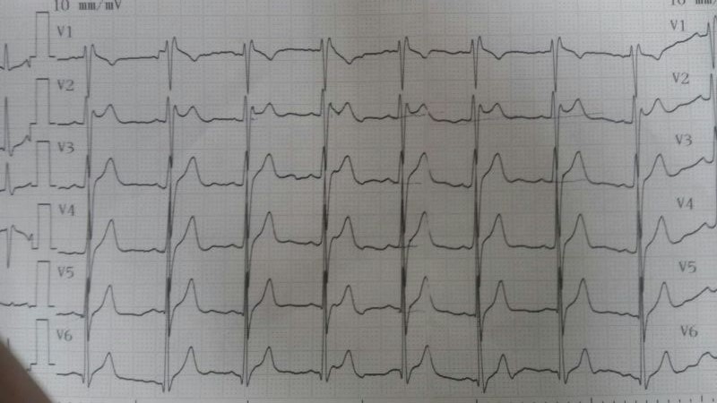 Brugada Tip 2