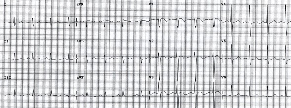 T Dalgası 13 Bilateral pulmoner embolili hastada inferior ve sağ prekordiyal derivasyonlarda T dalga inversiyonu