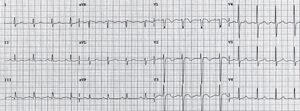 Bilateral pulmoner embolili hastada inferior ve sağ prekordiyal derivasyonlarda T dalga inversiyonu