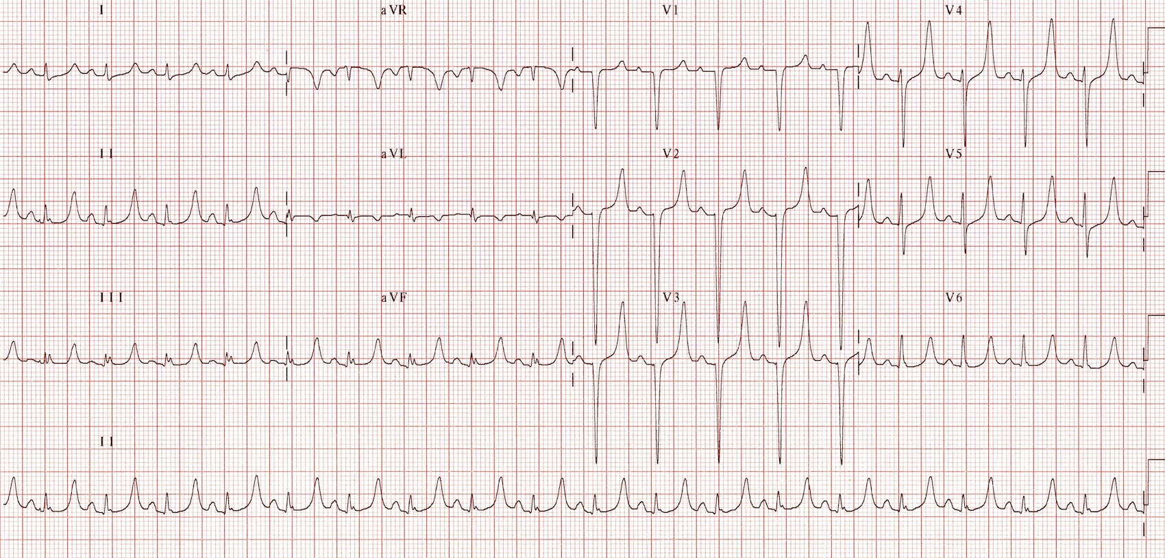 Kaynak: lifeinthefastlane.com - ecg