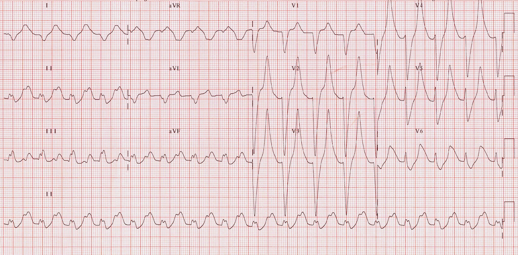 Kaynak: lifeinthefastlane.com - ecg