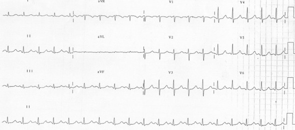 Hipomagnezemiye ikincil 510 ms QTc Kaynak: lifeinthefastlane.com - ecg