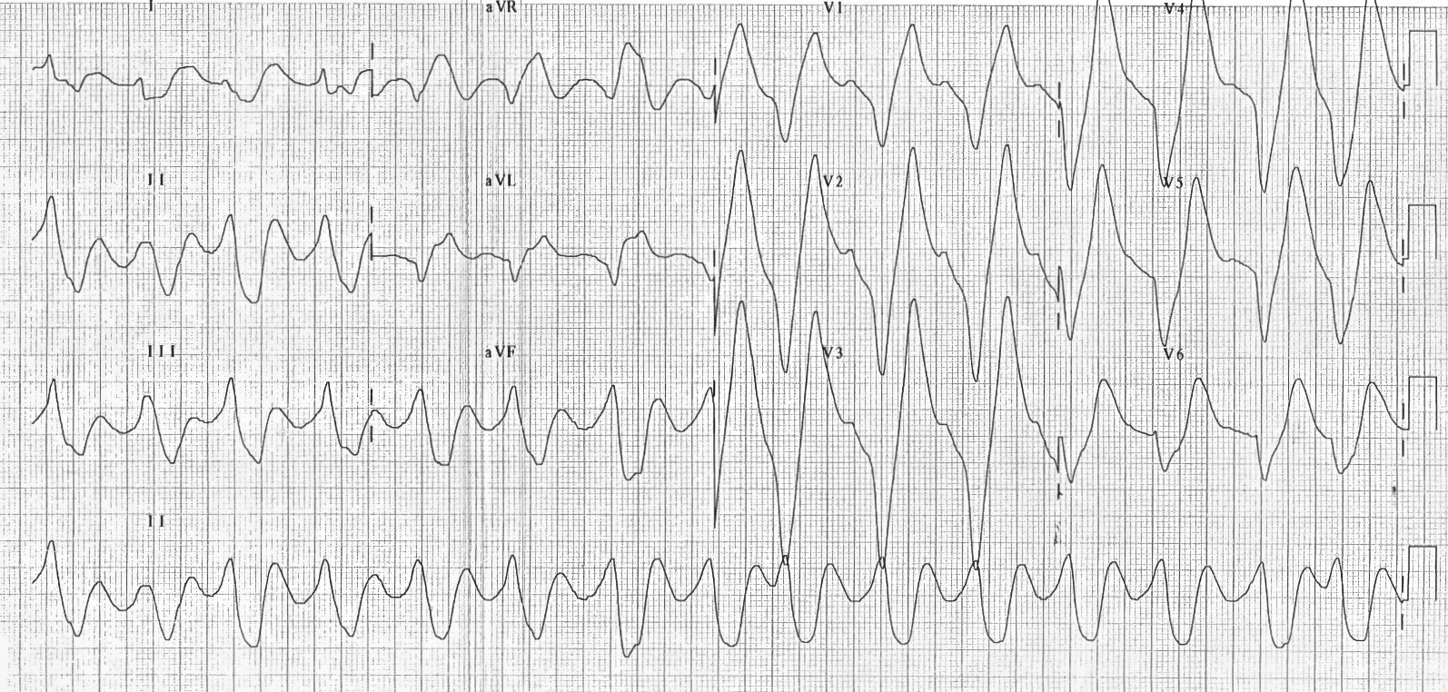Kaynak: www.lifeinthefastlane.com - ecg