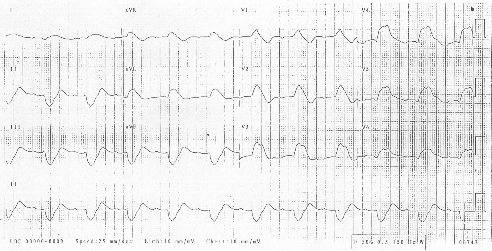Kaynak: lifeinthefastlane.com - ecg