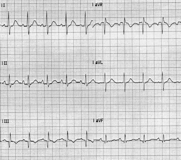 Akut pulmoner embolide S1Q3T3 patterni