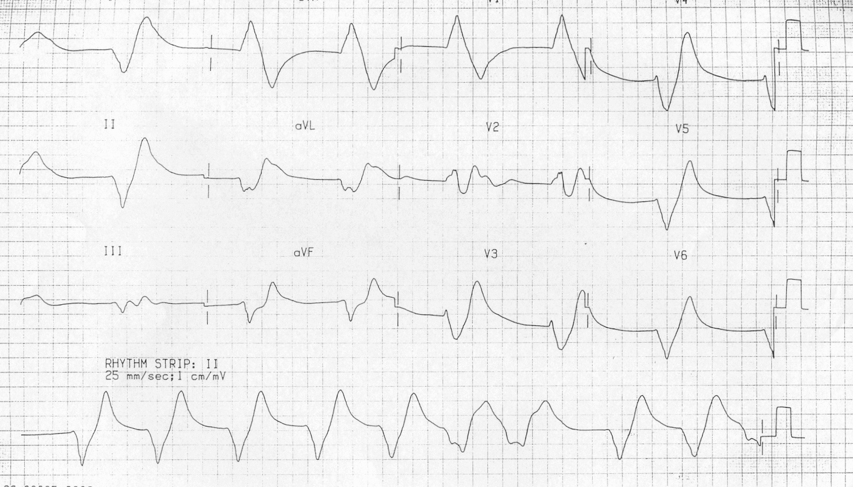 Kaynak: lifeinthefastlane.com - ecg