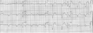 LBBB EKG