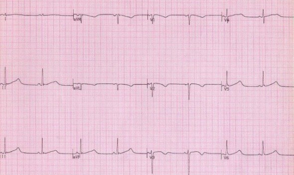 Konjenital uzun QT sendromuna bağlı 550 ms'lik QTc. Kaynak: lifeinthefastlane.com - ecg