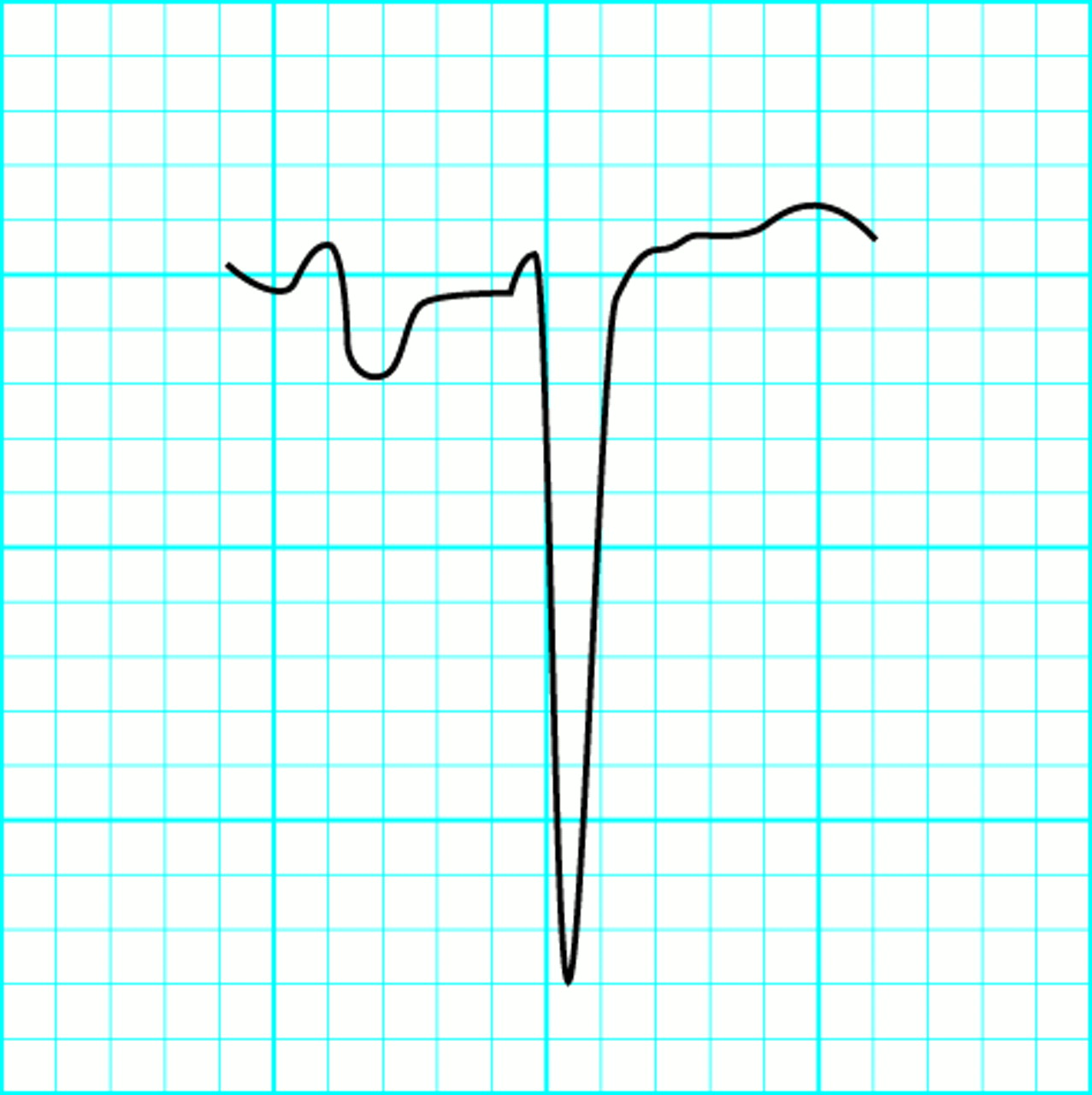 ABC of clinical electrocardiography: Conditions affecting the left side of the heart. BMJ 2002;324:1264.1