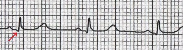 V6'da Normal Q Dalgası Kaynak: lifeinthefastlane.com - ECG Basics