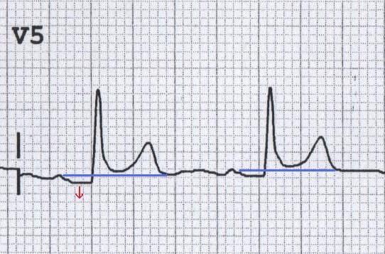 Akut perikardite bağlı V5'te PRsegment depresyonu (aynı zamanda konkav ST elevasyonu olduğuna dikkat ediniz). Kaynak: lifeinthefastlane.com - ecg