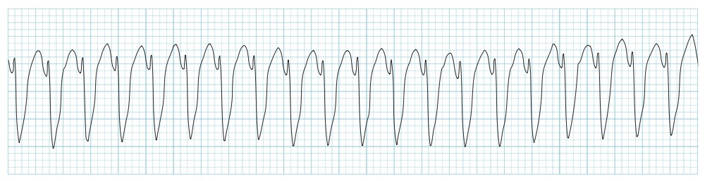 Kaynak: lifeinthefastlane.com - ecg