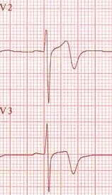 Wellens-2