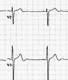 Wellens-2_2