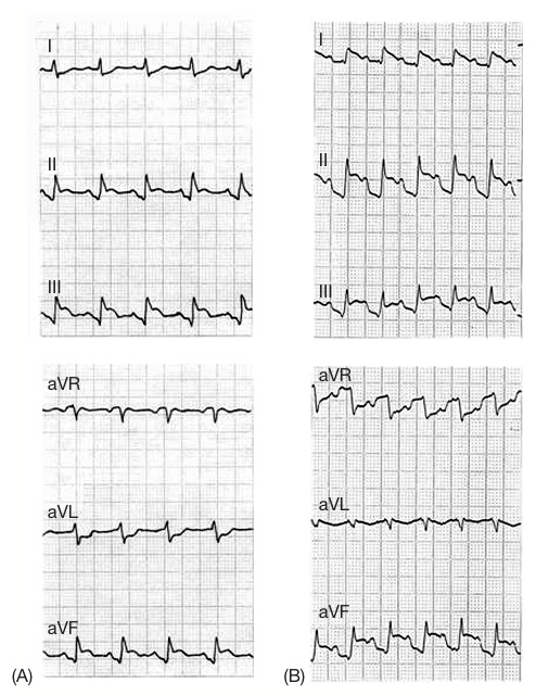 inferior STEMI'de eşlik eden atriyal infarktı gösteren PR depresyonu Kaynak: lifeinthefastlane.com - ecg
