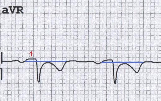 Akut perikardite bağlı aVR'de PR elevasyonu (resiprokal ST depresyonuna dikkat ediniz). Kaynak: lifeinthefastlane.com - ecg