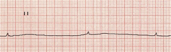 Bradikardi Kaynak: lifeinthefastlane.com - ecg