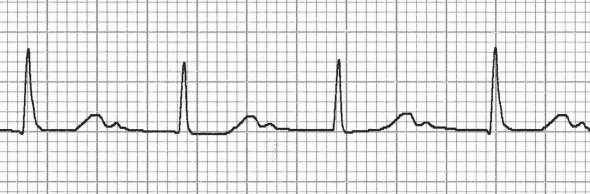 Belirgin 1. derece kalp bloğunda saklı P dalgaları 