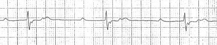 2:1 iletimli 2. derece kalp bloğunda saklı P dalgaları