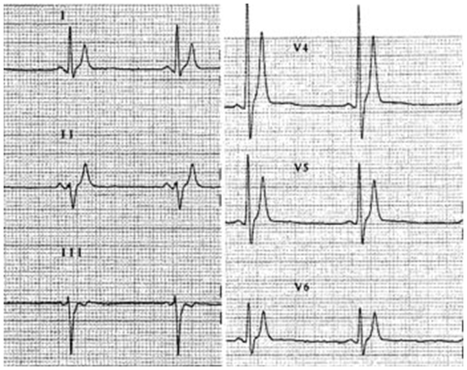 Kısa QT sendromu hastalarında sivri T dalgaları ile çok kısa QT(<300 ms). Kaynak: lifeinthefastlane.com - ecg