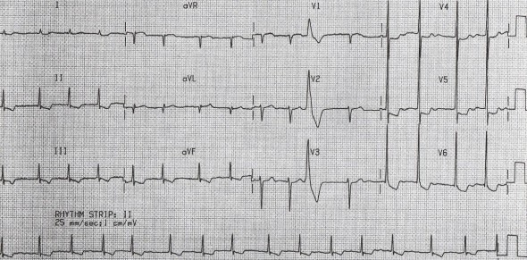 Digoksine bağlı kısa QT aralığı (QT 260 ms, QTc yaklaşık 320 ms) Kaynak: lifeinthefastlane.com - ecg