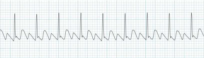 Kaynak: lifeinthefastlane.com - ecg