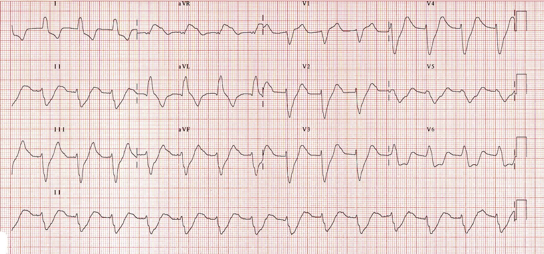 Kaynak: lifeinthefastlane.com - ecg