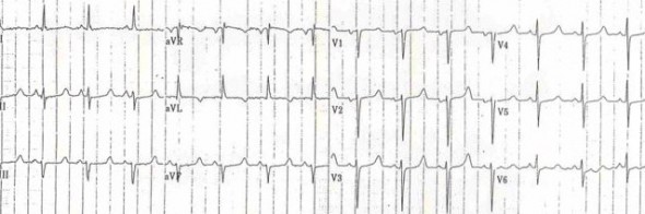 Hipokalsemiye bağlı 510 ms'lik QTc Kaynak: lifeinthefastlane.com - ecg
