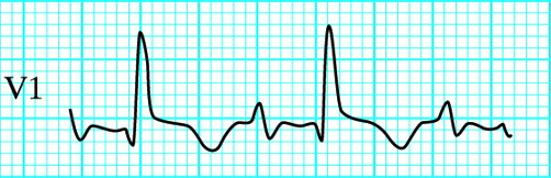 ABC of clinical electrocardiography: Conditions affecting the right side of the heart. BMJ 2002;324:1201