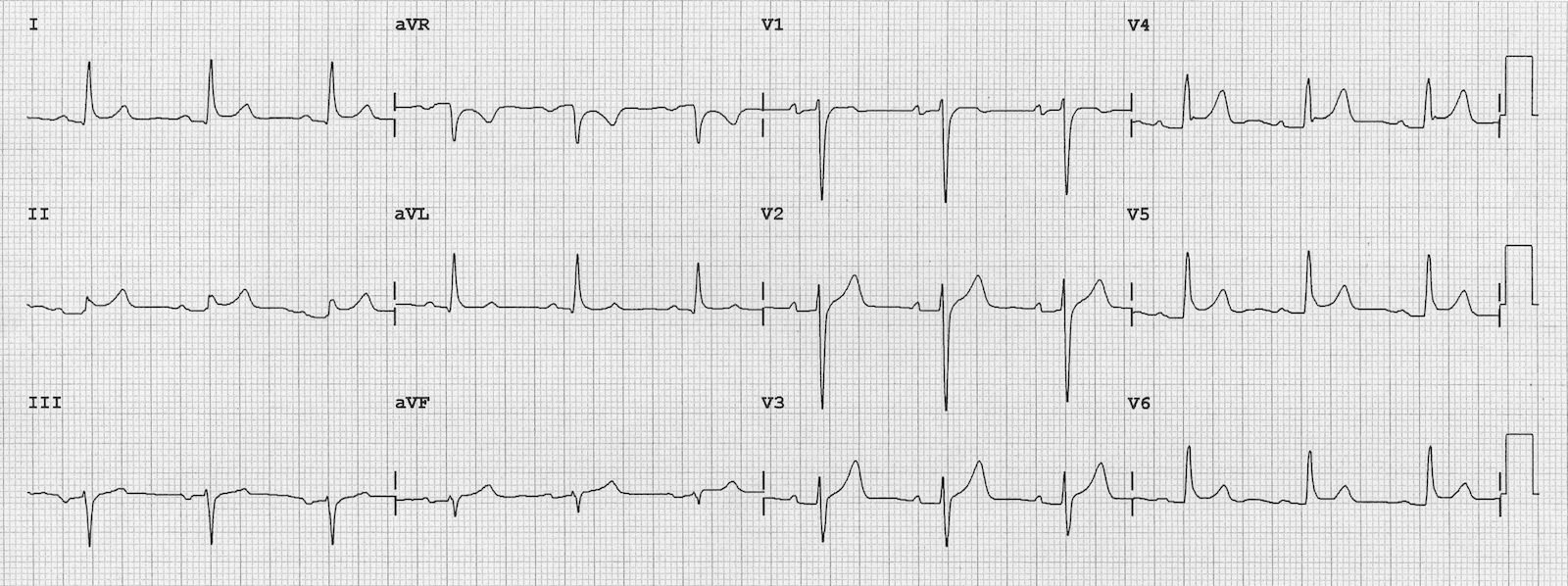 Akut perikarditte tipik EKG Kaynak: lifeinthefastlane.com - ecg