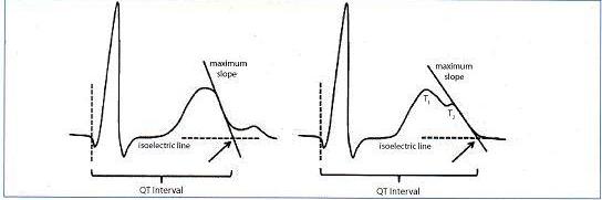 QT aralığı QRS kompleksi başlangıcı ve T dalgası sonu arası mesafe olarak tanımlanır. Maksimum eğim kesişimi metodu, T dalgası bitimini izoelektrik hat ile aşağı maksimum eğim üzerine çizilen tanjant çizgisi ile kesişimi olarak kabul eder(solda). Çentikli T dalgası varlığında (sağda), QT aralığı QRS başlangıcından izoelektrik hat ve ikinci çentiğin(T2) maksimum eğiminin kesişim noktası üzerinden çizilen tanjant çizgisi ile hesaplanır. Kaynak: lifeinthefastlane.com - ecg