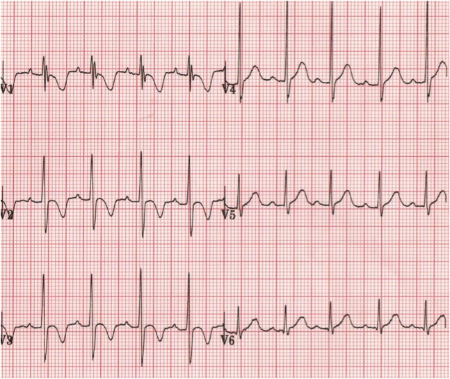 Pediatrik EKG: V1’de R dalgası