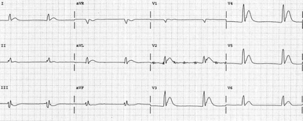 Hiperkalsemiye bağlı belirgin QTc kısalması(260 ms). Kaynak: lifeinthefastlane.com - ecg