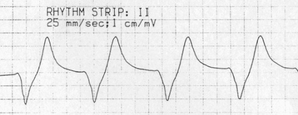 Sinüs dalgası Kaynak: lifeinthefastlane.com - ecg