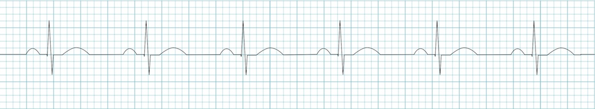Kaynak: lifeinthefastlane.com - ecg