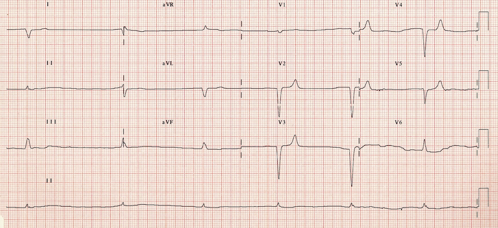 Kaynak: lifeinthefastlane.com - ecg