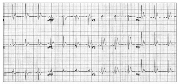 Konjenital kısa QT sendromuna bağlı uzun, sivri T dalgaları ile birlikte çok kısa QTc (280 ms). Kaynak: lifeinthefastlane.com - ecg