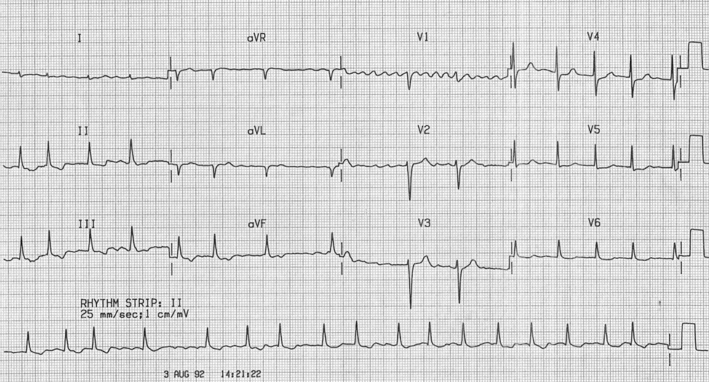 Kaynak : lifeinthefastlane.com - ECG library