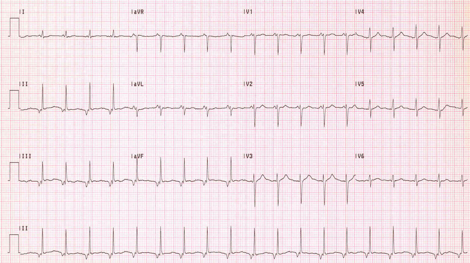 Akselere Kavşak Ritmi 2 Kaynak: lifeinthefastlane.com - ECG