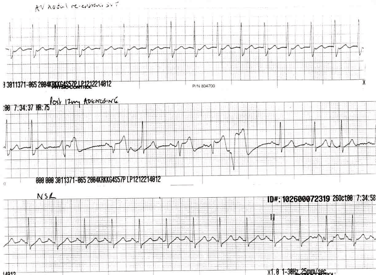 Kaynak : lifeinthefastlane.com - ECG library