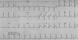 Kaynak : lifeinthefastlane.com - ECG library