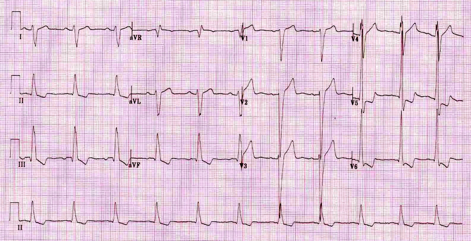 Kaynak : lifeinthefastlane.com - ECG library