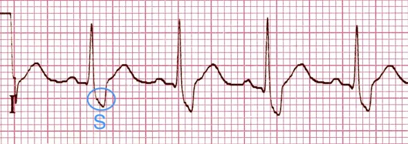 I. derivasyonda geniş uzamış S dalgası. Kaynak : lifeinthefastlane.com - ECG library