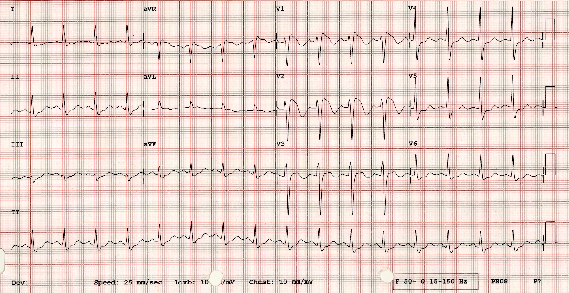 Brugada Sendromu Kaynak : lifeinthefastlane.com - ECG library