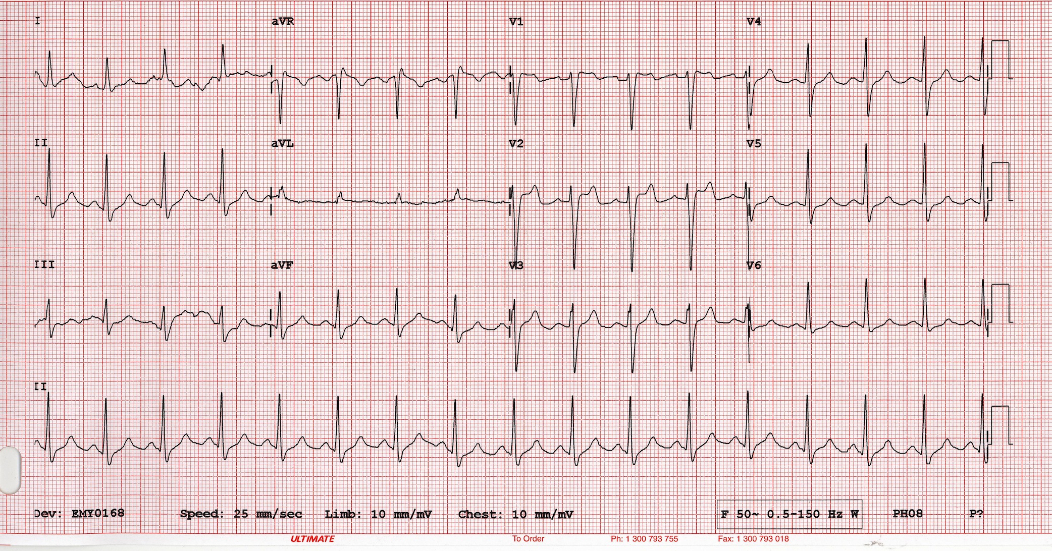 Brugada tip 2 Kaynak : lifeinthefastlane.com - ECG library