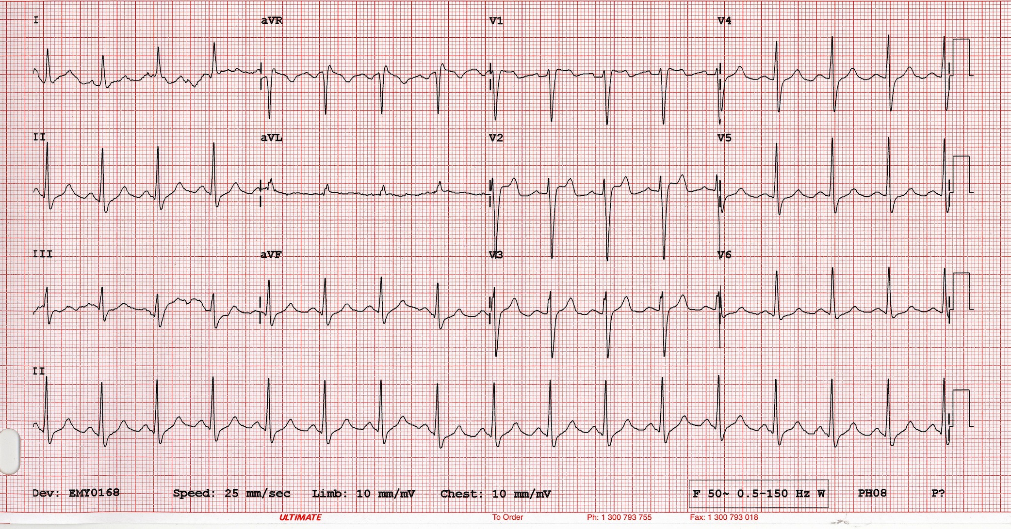 Brugada tip 2 Kaynak : lifeinthefastlane.com - ECG library