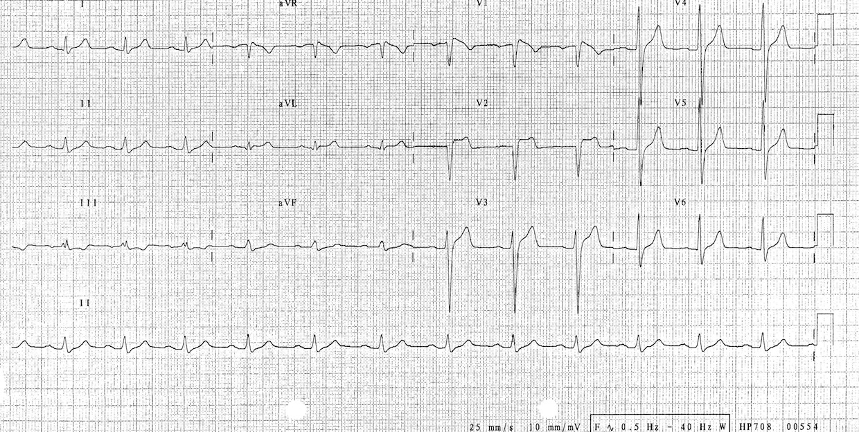 Brugada tip 3 Kaynak : lifeinthefastlane.com - ECG library